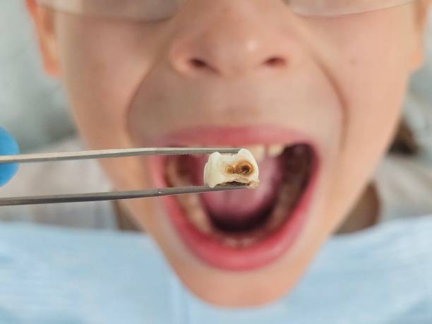 Best Emergency Dental Extractions in Horizon West, FL